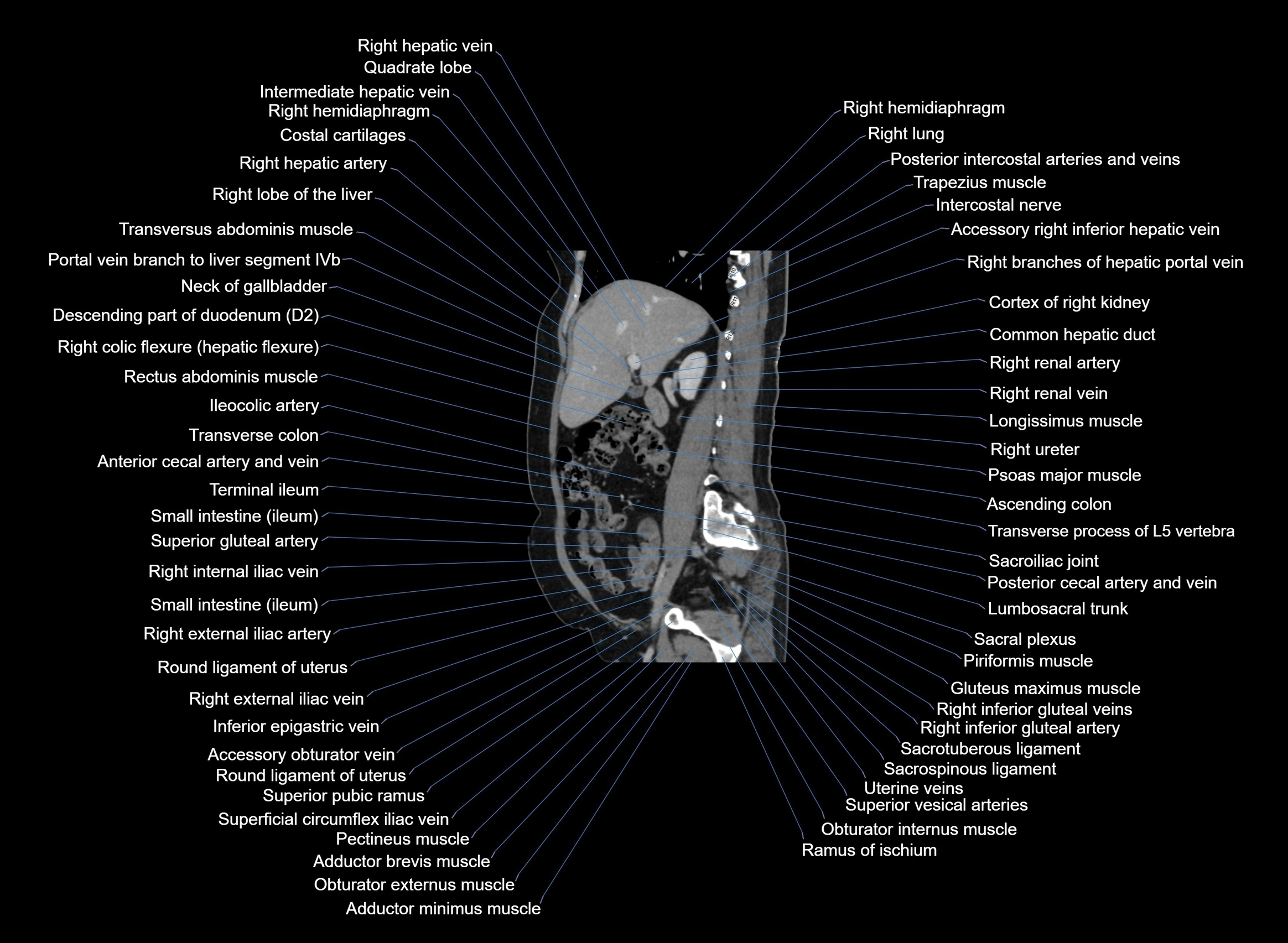 CT Abdomen sagittal cross sectional anatomy labelled radiology image -00074.webp